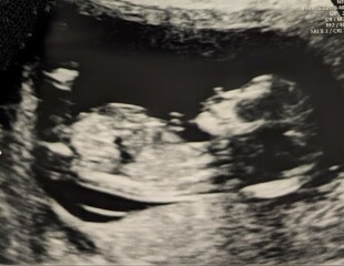 Boy or girl nub? Or both?!