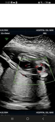 Has anyone been told the wrong gender at 20 week scan?
