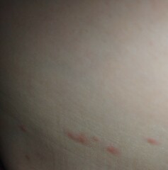 Chickenpox? Pics?