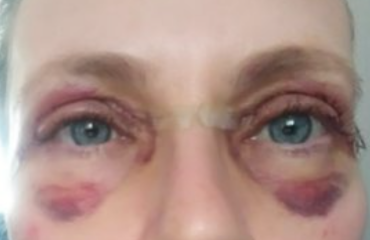 Upper Blepheroplasty