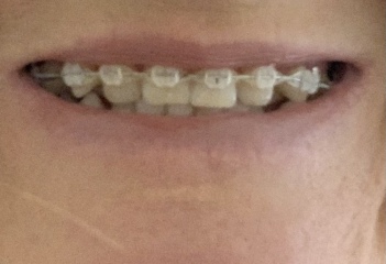 Adult Braces