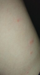 Chickenpox? Pics?