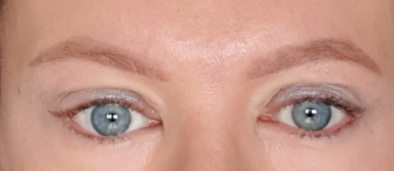 Upper Blepheroplasty