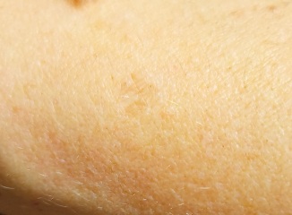 Darker patch on skin 