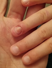 4yo trapped finger, 5 weeks later what's happened??