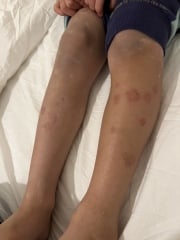Anyone seen this type of rash before? Pic (Plus recurrent temperature)