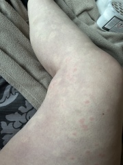 Red patches on legs after exposure to cold 