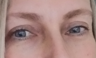 Upper Blepheroplasty