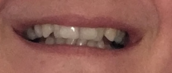 Adult Braces