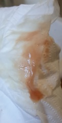 Implantation bleeding ⚠️