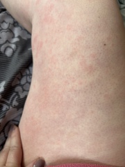 Red patches on legs after exposure to cold 