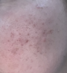 To be at my wits end about my skin!!