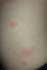 Chickenpox? Pics?