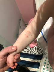 What's this rash?