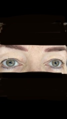 Upper Blepheroplasty