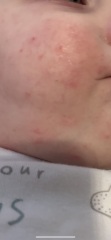 Does ds need to see a doctor re rash reappearing constantly