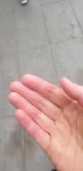Is this hand Psoriasis?