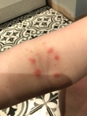What's this rash?