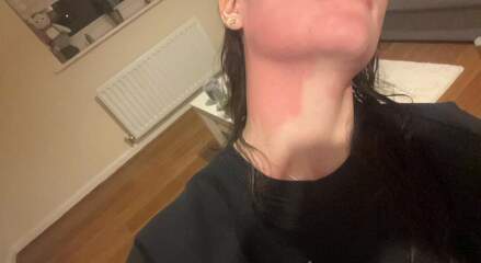 Advice on red skin flare ups please