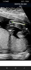 Has anyone been told the wrong gender at 20 week scan?