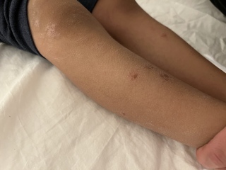 Anyone seen this type of rash before? Pic (Plus recurrent temperature)