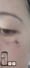 Mole removal 