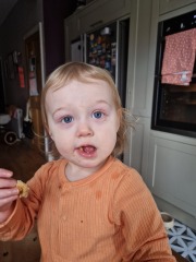 Periorbital cellulitis 