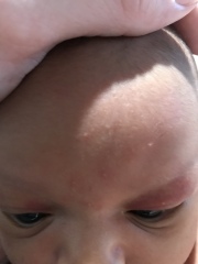 Baby face rash/spots?!