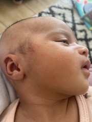 Baby rash