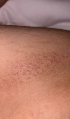 Rash inner thigh