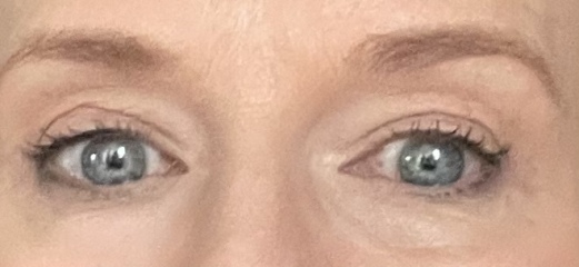 Upper Blepheroplasty