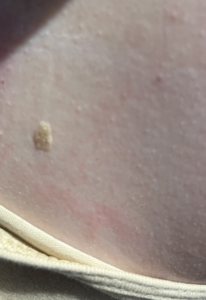 Does this mole Look dodgy?