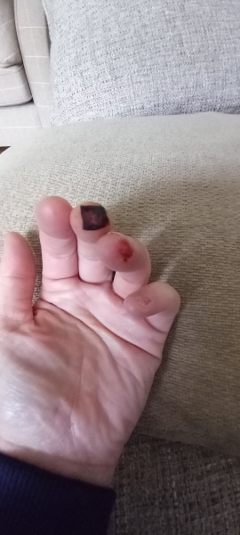 How to dress and open finger wound