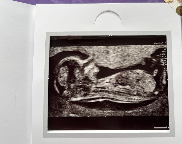 Gender guesses! 20 week scan 😁✨