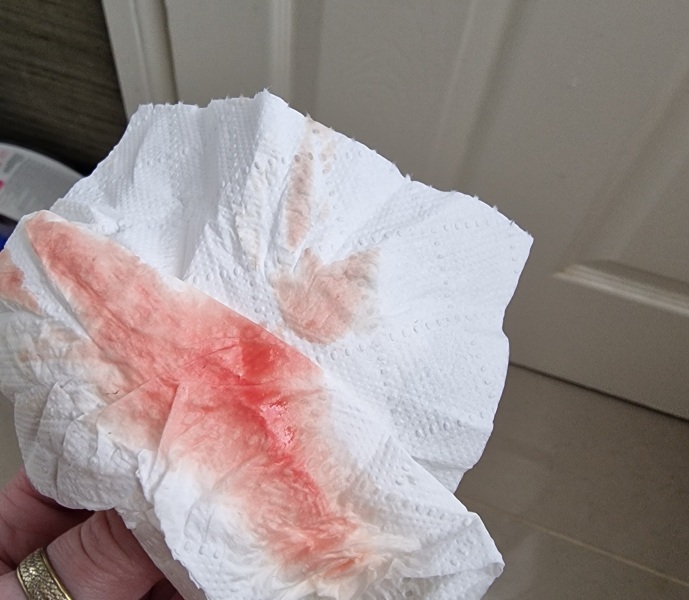 7 Weeks pregnant passing small blood clots
