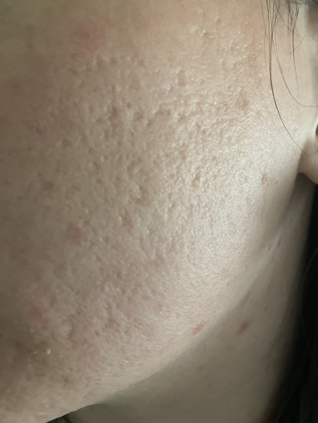 Treatment for severe acne scarring?!