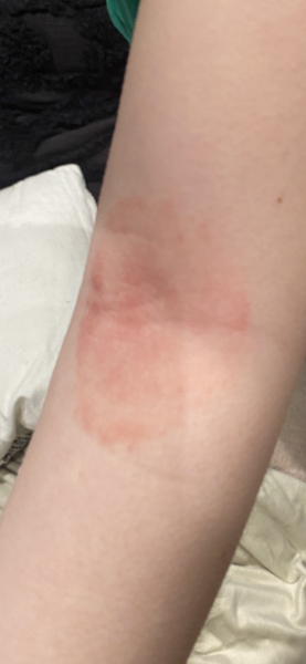 Feeling like the worst parent- potential rheumatic fever