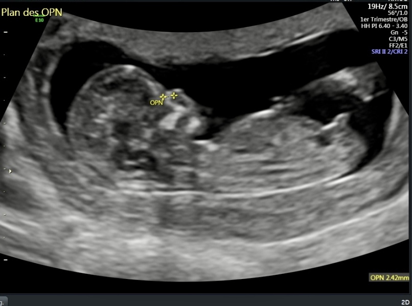 DP hoping for a girl… 12 week scan suggests otherwise?