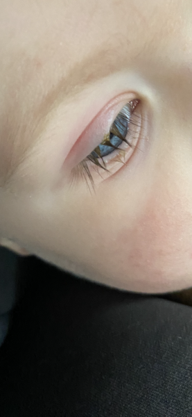 17 month old swollen eye lid, and some yellow discharge 