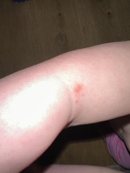 Chickenpox or HFM?