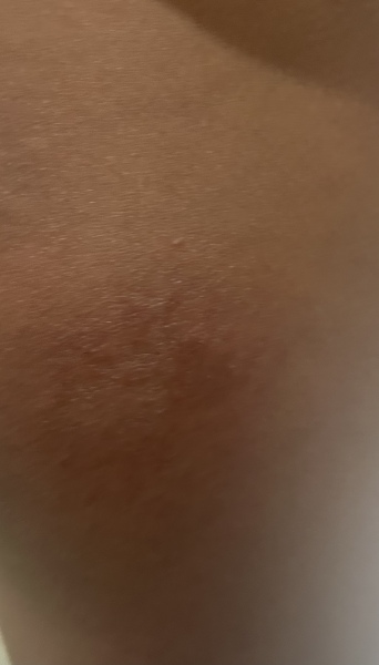 Ringworm