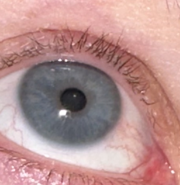 Went to bed fine, woke up with eyelid pain (pic)