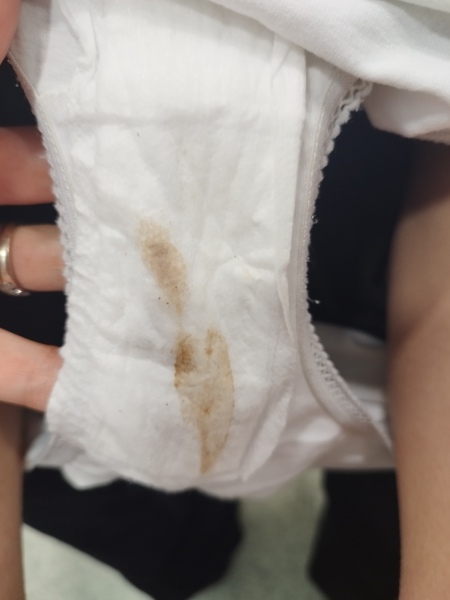 Really scared, 2 previous miscarriages - is this implantation? (Pic)