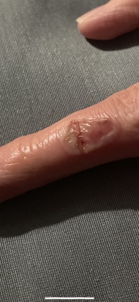 What's best to help this burn heal?
