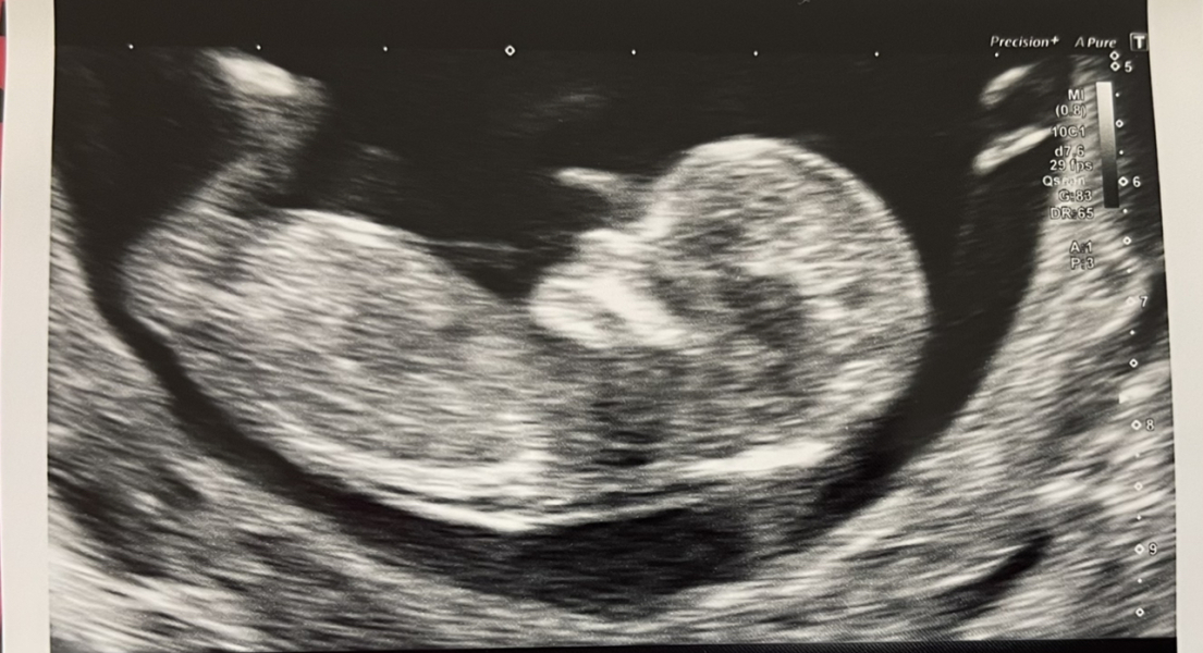 12 weeks 5 days - Blue or Pink? 