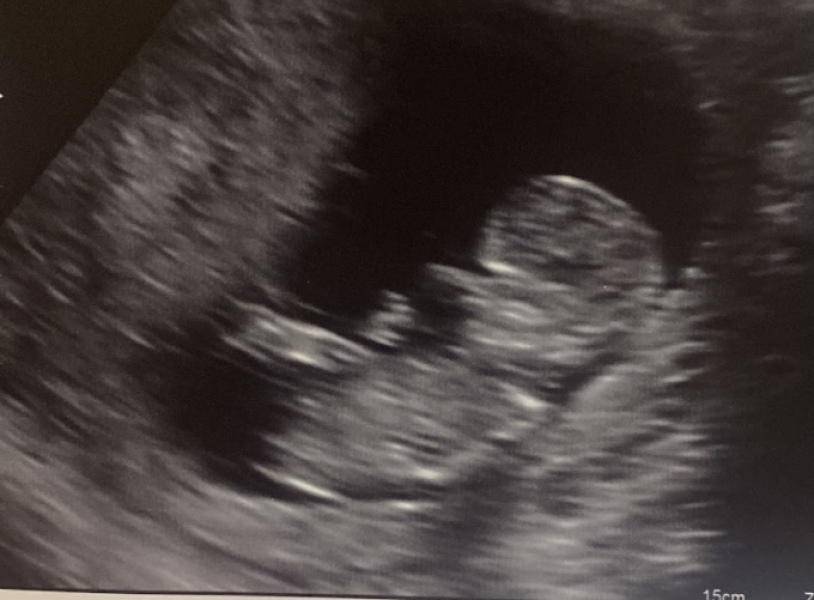 Baby had legs crossed, any guesses on gender?