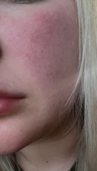 Wtf is going on with my face?!