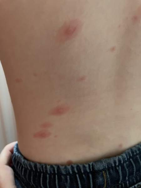 Is this normal re chicken pox?