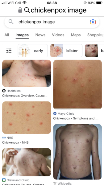 Does this look like chicken pox?