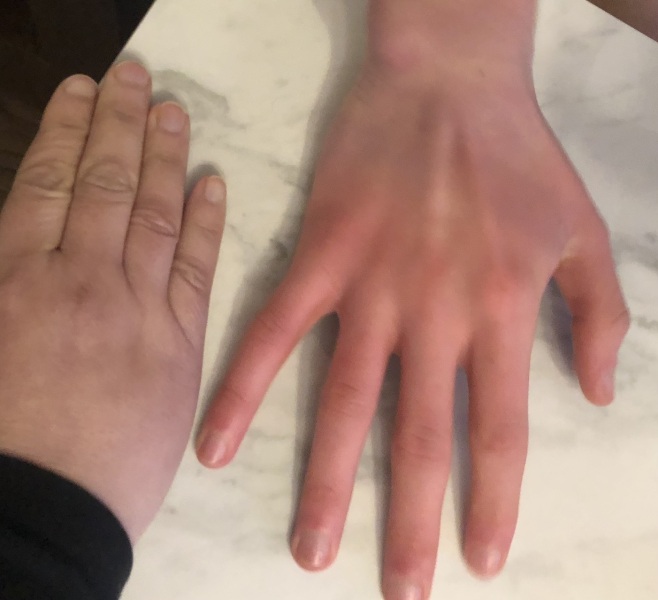 Cold hands